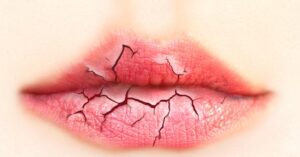 Arganolie, De Oplossing Voor Gebarsten Lippen