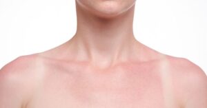 Leer Hier Hoe je een Zonverbrande Huid Kunt Behandelen