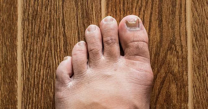 nagels-en-voedseltekorten1