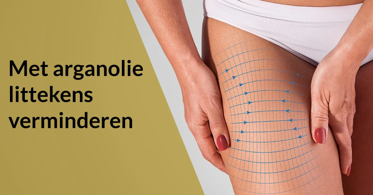 vrouw elasticiteit dijen littekens striae verminderen